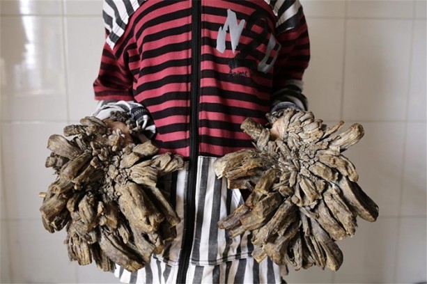 Foto - Elleri ve ayakları ağaca dönüşüyor!