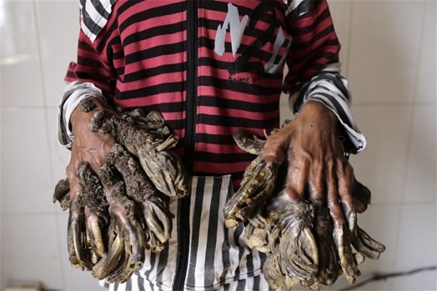 Foto - Elleri ve ayakları ağaca dönüşüyor!