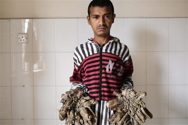 Elleri ve ayakları ağaca dönüşüyor!