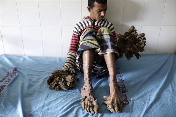 Foto - Elleri ve ayakları ağaca dönüşüyor!