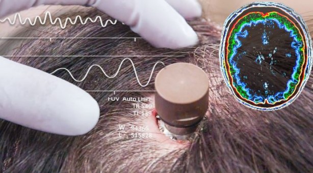 Foto - Elon Musk sonunda bunu da yaptı! İlk defa bir insan beynine çip taktılar