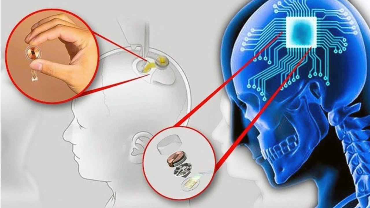 Foto - Elon Musk'ın Neuralink şirketi bir hastaya daha çip taktı