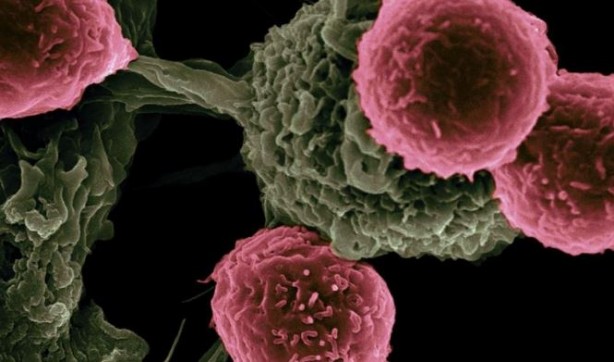 Foto - En erken evre kanser belirtileri açıklandı! Zamanlama hayat kurtarıyor