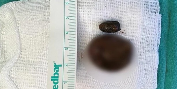 Foto - En ilginç olay: Burnunun içinden çıkan şok etti!