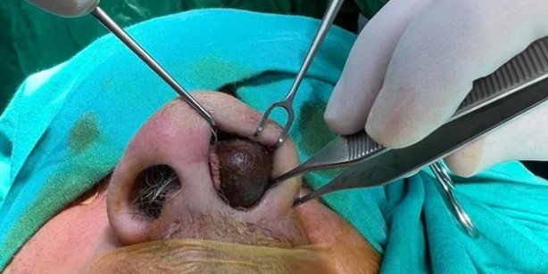 Foto - En ilginç olay: Burnunun içinden çıkan şok etti!