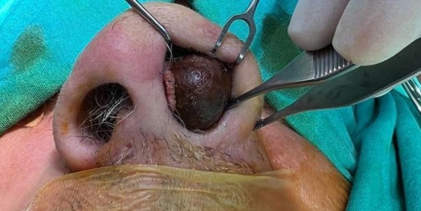 En ilginç olay: Burnunun içinden çıkan şok etti!