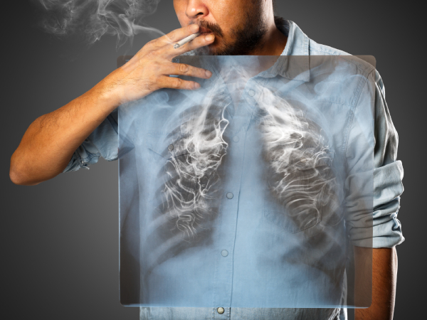 Foto - En ölümcül kanser türüne dikkat! O bulgular akciğer kanseri belirtisi olabilir!