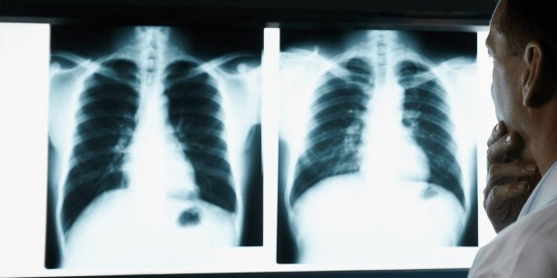 Foto - En ölümcül kanser türüne dikkat! O bulgular akciğer kanseri belirtisi olabilir!