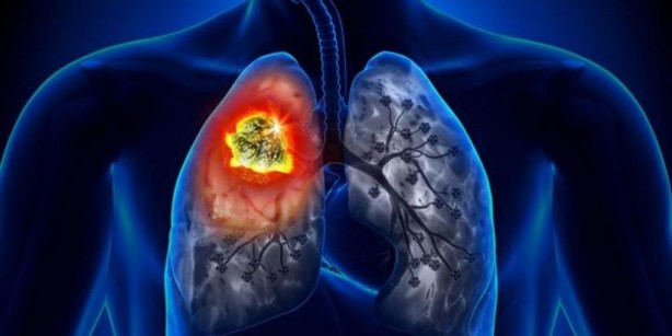 Foto - En ölümcül kanser türüne dikkat! O bulgular akciğer kanseri belirtisi olabilir!