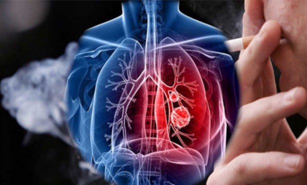 Foto - En ölümcül kanser türüne dikkat! O bulgular akciğer kanseri belirtisi olabilir!