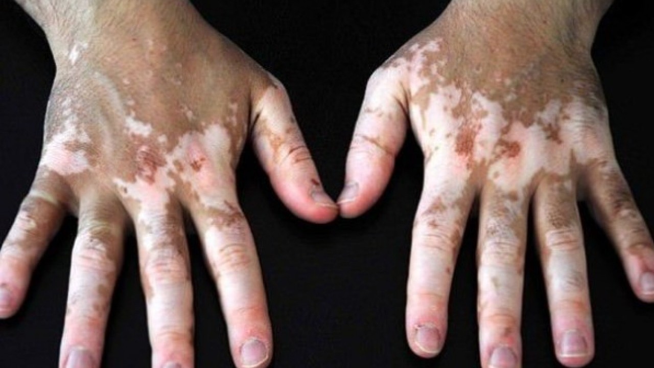 Foto - Erken tanı çok önemli: Bu işaretleri hafife almayın!