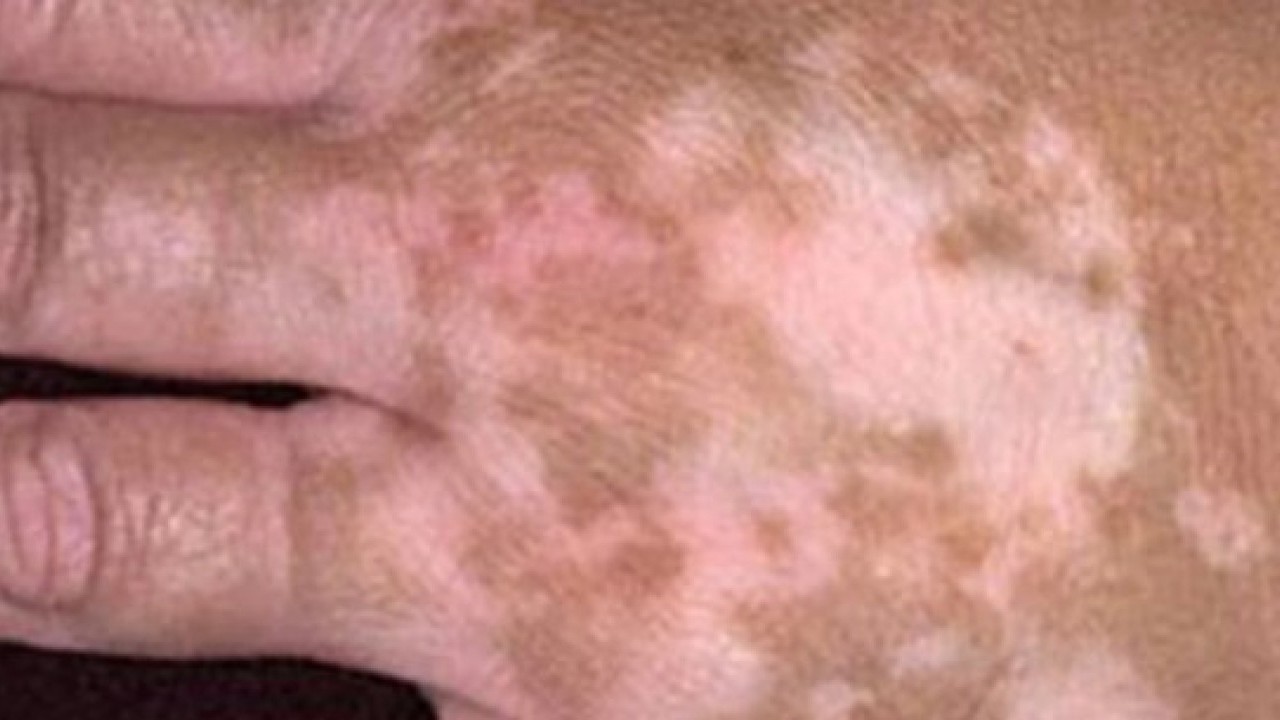 Foto - Erken tanı çok önemli: Bu işaretleri hafife almayın!