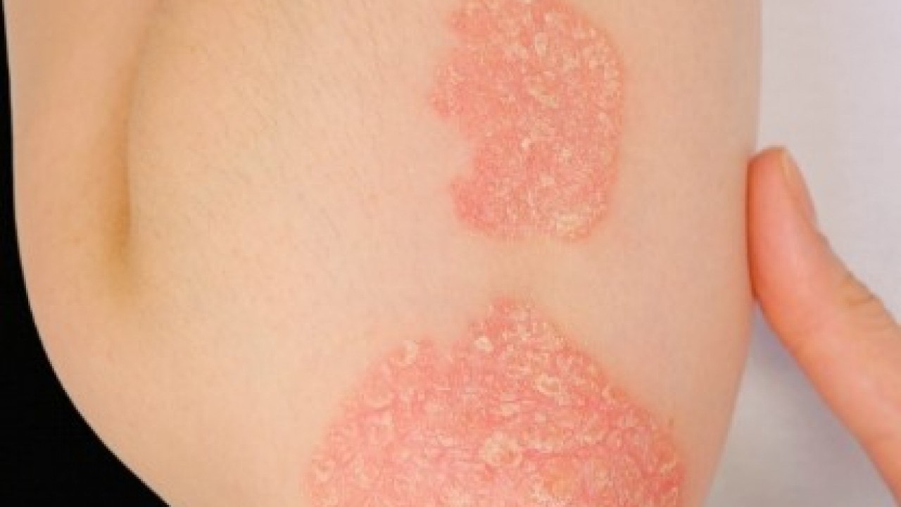 Foto - Erken tanı çok önemli: Bu işaretleri hafife almayın!