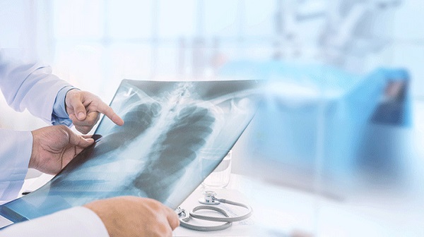 Foto - Erken teşhis çok önemli! Akciğer kanserinin 8 belirtisi