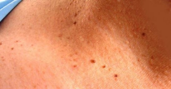 Foto - Et benlerinden kurtulmak çok kolay!