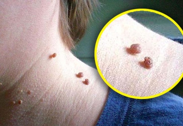 Et benlerinden doğal yöntemlerle kurtulun!