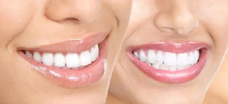 Foto - Evde diş beyazlatma yöntemleri neler? İşte o mucize teknikler… Diş beyazlatma işlemi nedir, nasıl yapılır?