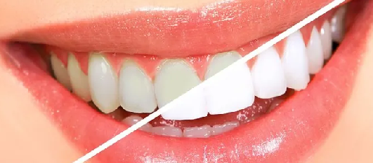 Foto - Evde diş beyazlatma yöntemleri neler? İşte o mucize teknikler… Diş beyazlatma işlemi nedir, nasıl yapılır?