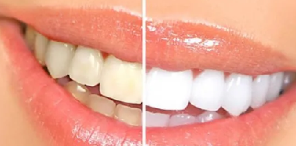 Foto - Evde diş beyazlatma yöntemleri neler? İşte o mucize teknikler… Diş beyazlatma işlemi nedir, nasıl yapılır?
