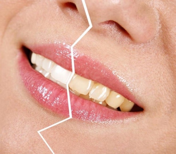 Foto - Evde diş nasıl beyazlatılır?