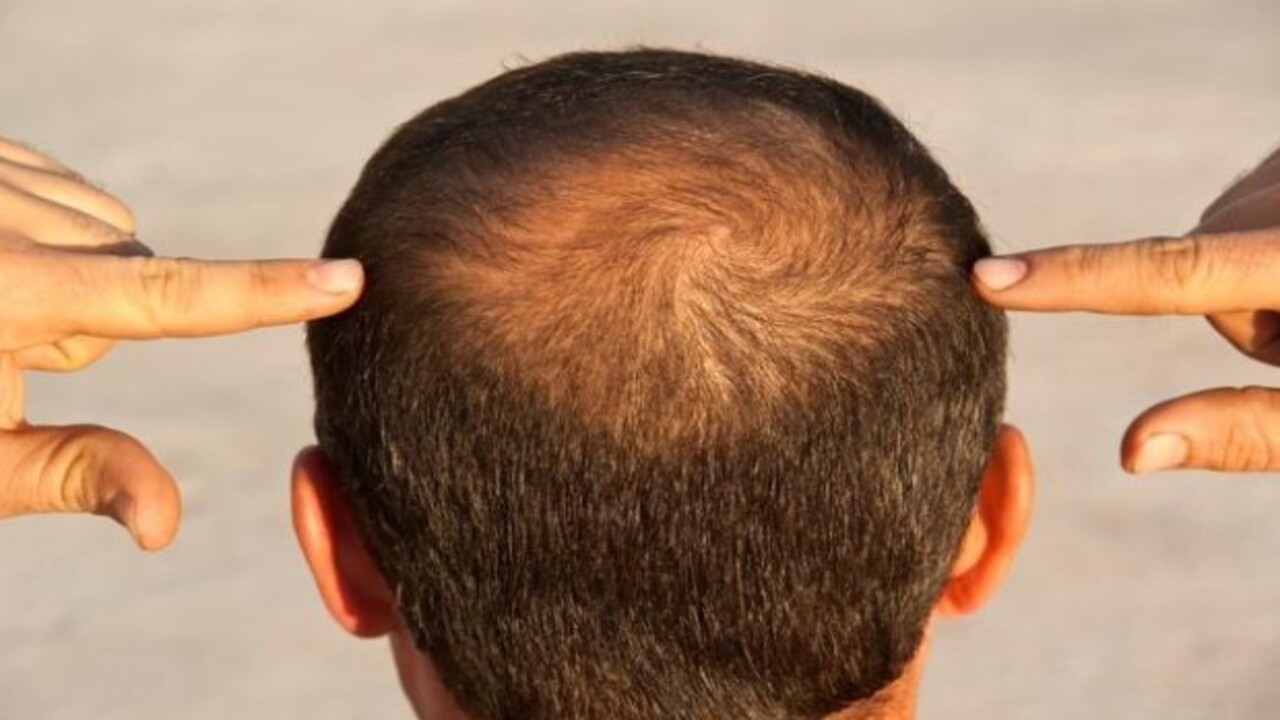 Evde hazırlayıp 15 dakika bekletin! İşte kel bölgelerde saç çıkaran doğal yöntem