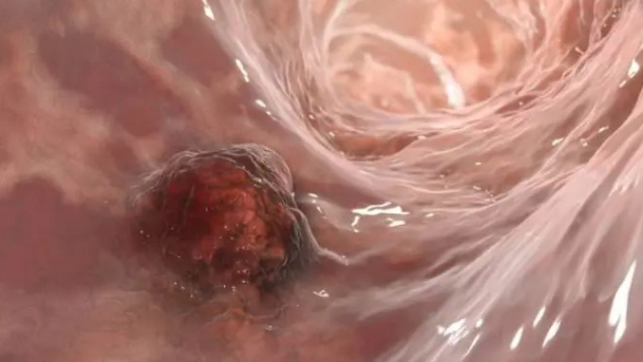 Foto - Fazla tüketenler dikkat: Meğer kansere davetiye çıkarıyormuş!