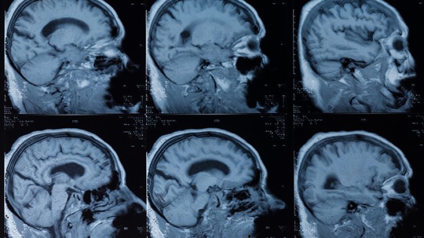 Foto - Felç belirtileri nasıl anlaşılır? İşte felçten korunma yolları