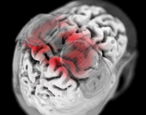 Foto - Felçlilere umut oldu! Beyne takılan cihazla yürümeye başladı