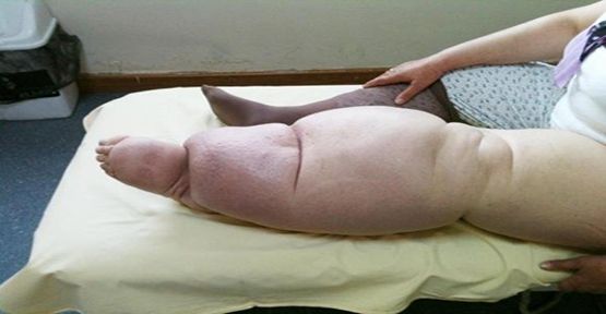 Foto - Fil hastalığına karşı aman dikkat! Bunları yaparsanız...