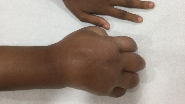 Foto - Fil hastalığına karşı aman dikkat! Bunları yaparsanız...