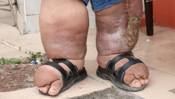 Foto - Fil hastalığına karşı aman dikkat! Bunları yaparsanız...