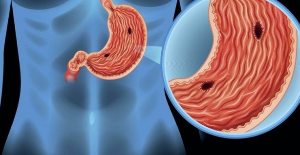 Foto - Gastrite karşı kullanabileceğiniz 8 doğal ilaç