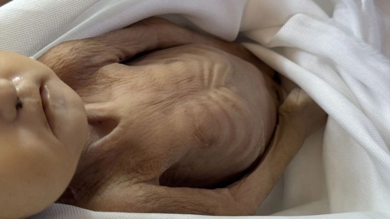 Foto - Gazze'de 5 aylık bir bebek açlıktan şehid oldu! Müslümanlar kıyameti koparması gerekirken suskun...