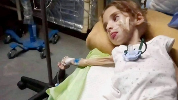 Foto - Gazze'de 50.000'den fazla çocuk açlık nedeniyle acil tedaviye muhtaç!