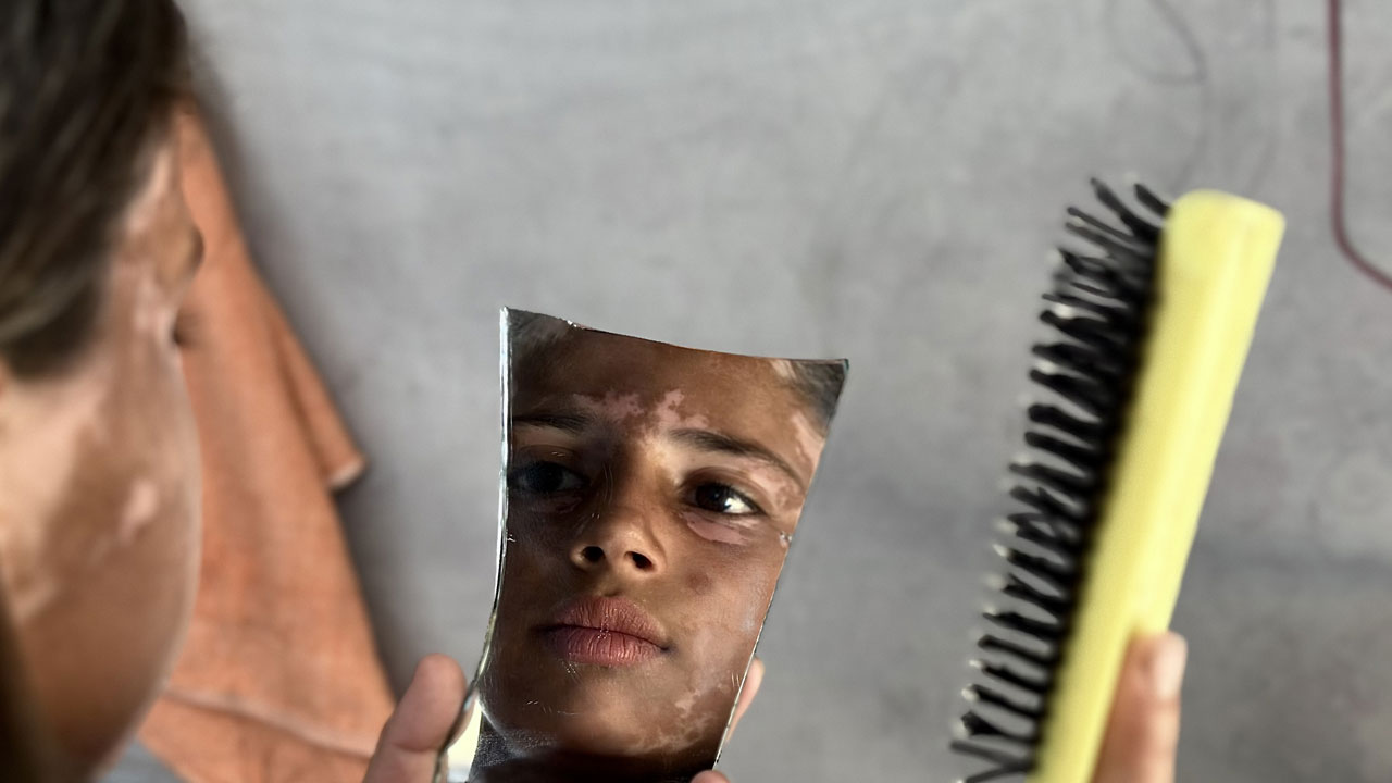 Foto - Gazze'de çocuk olmak! 10 yaşındaki Lana'nın saçları ağardı