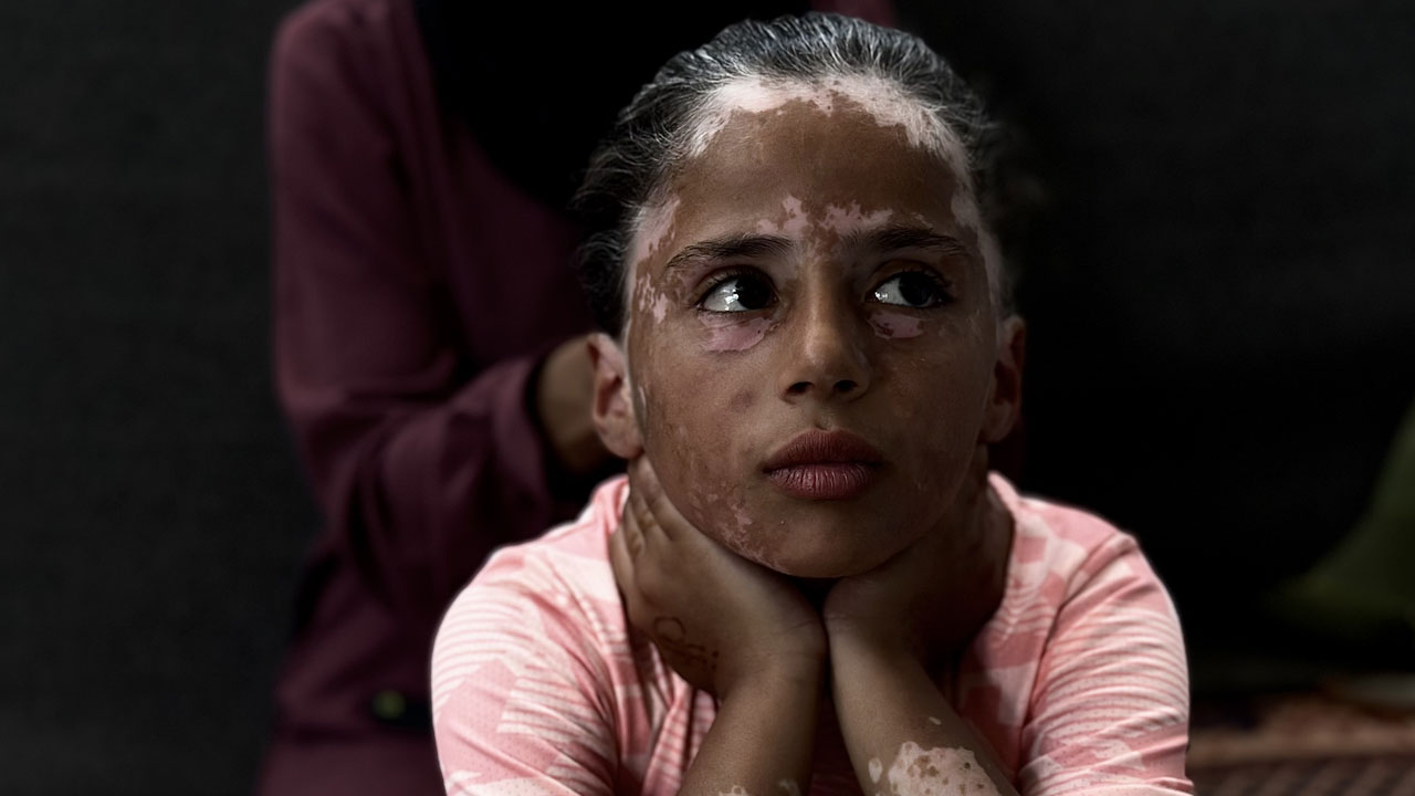 Gazze'de çocuk olmak! 10 yaşındaki Lana'nın saçları ağardı