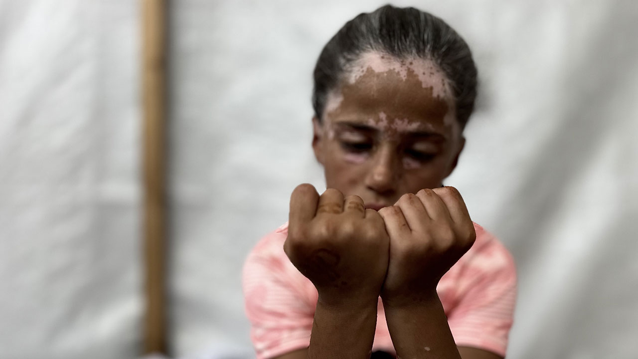 Foto - Gazze'de çocuk olmak! 10 yaşındaki Lana'nın saçları ağardı