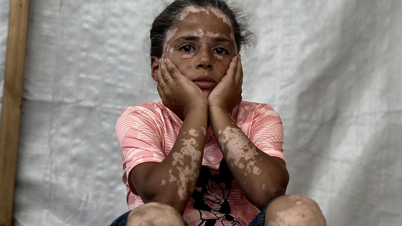 Foto - Gazze'de çocuk olmak! 10 yaşındaki Lana'nın saçları ağardı