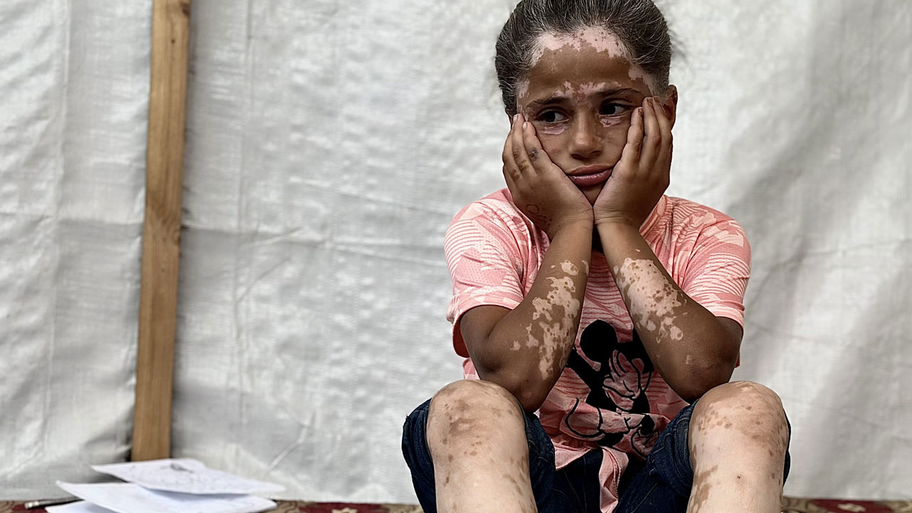 Foto - Gazze'de çocuk olmak! 10 yaşındaki Lana'nın saçları ağardı