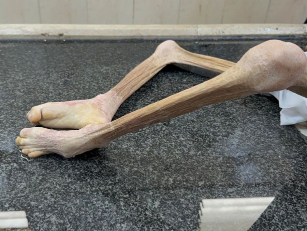 Foto - Gazze'de yetersiz beslenme sonucu ölen 10 yaşındaki Filistinli çocuktan geriye bu fotoğraflar kaldı! İşte "Allah bu İsrail’in tez zamanda belasını versin" dedirten kareler