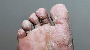 Foto - Geçmeyen ayak mantarına reçete listede ilk sırada yer aldı: Karşı koruma geldi! 1 bardağı 20 dakikada bakın nasıl bitiriyor!