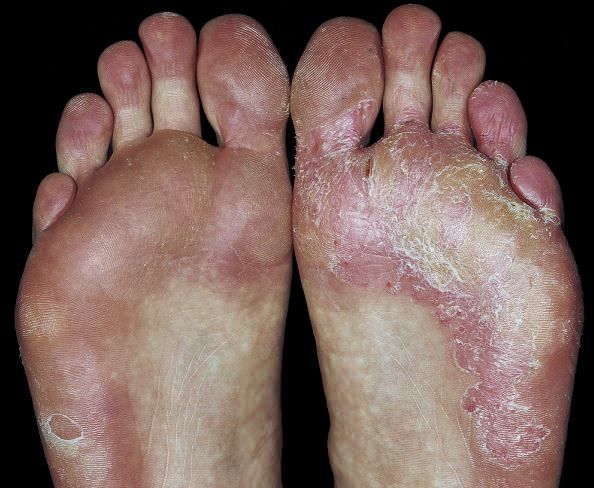 Foto - Geçmeyen ayak mantarına reçete listede ilk sırada yer aldı: Karşı koruma geldi! 1 bardağı 20 dakikada bakın nasıl bitiriyor!