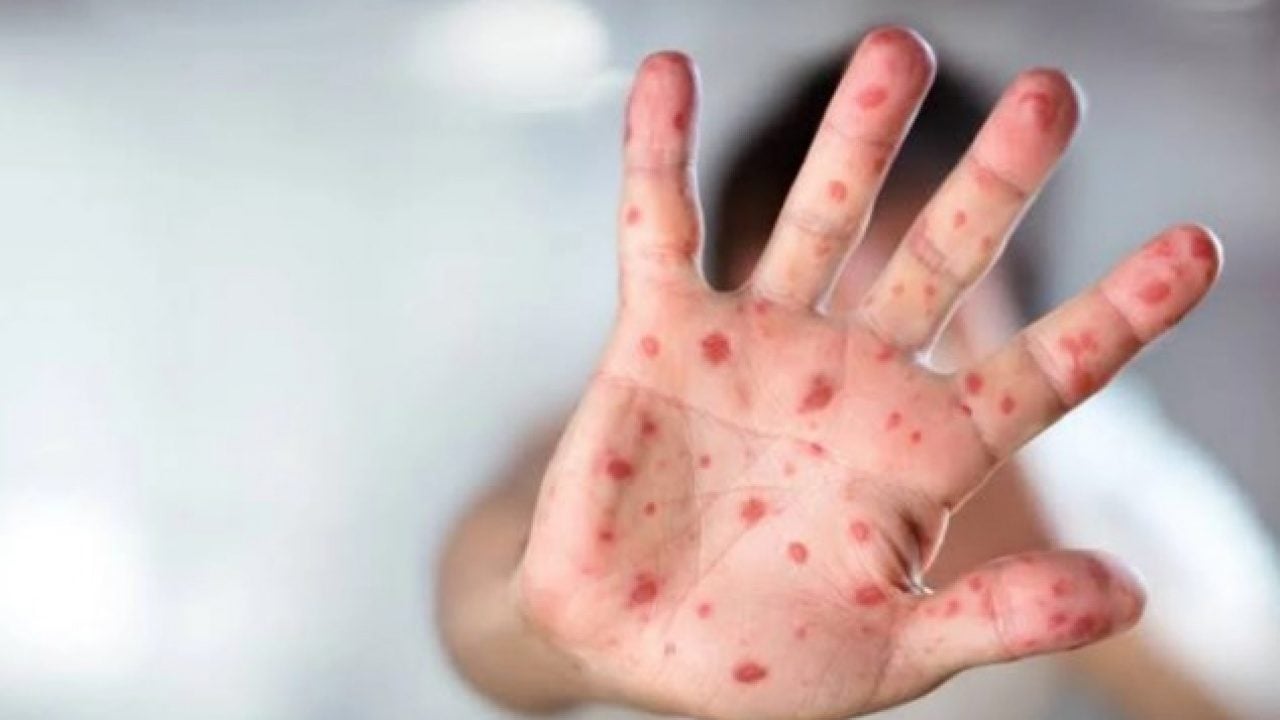Foto - Geçmişin korkutan hastalığı geri döndü! Aşı karşıtlığı vakaları tırmandırdı