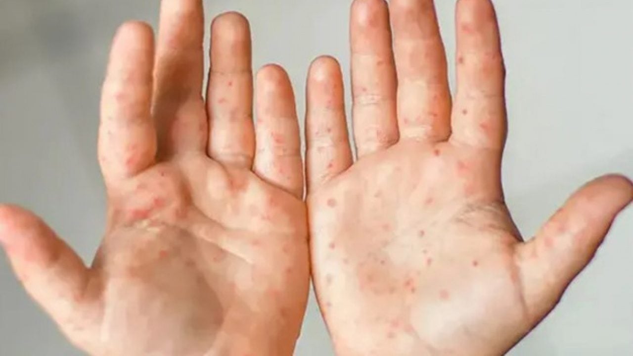 Foto - Geçmişin korkutan hastalığı geri döndü! Aşı karşıtlığı vakaları tırmandırdı