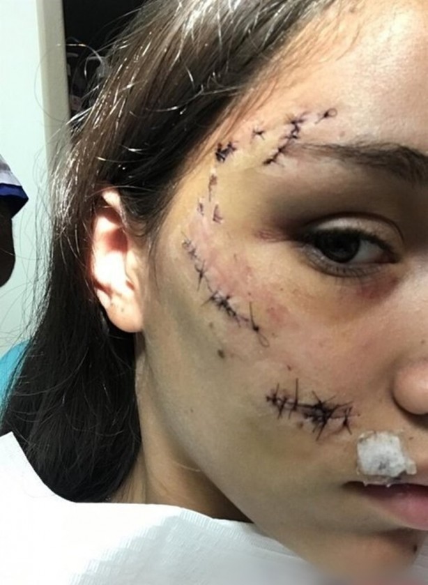 Foto - Genç kız dehşeti yaşadı! Köpek yüzünü parçaladı