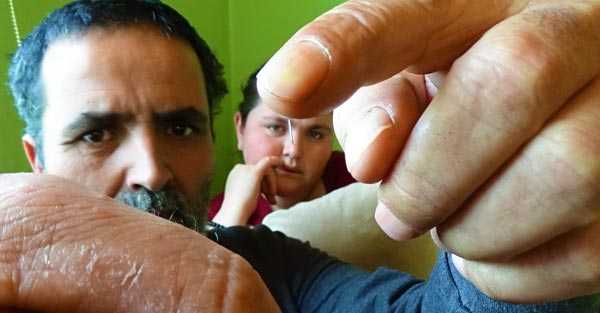 Foto - Genç kızın vücudundan metal çıkıyor!