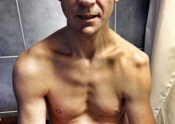 Foto - Gençlerde omuz çıkığı daha zor iyileşiyor