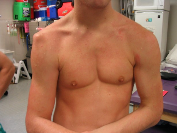 Foto - Gençlerde omuz çıkığı daha zor iyileşiyor