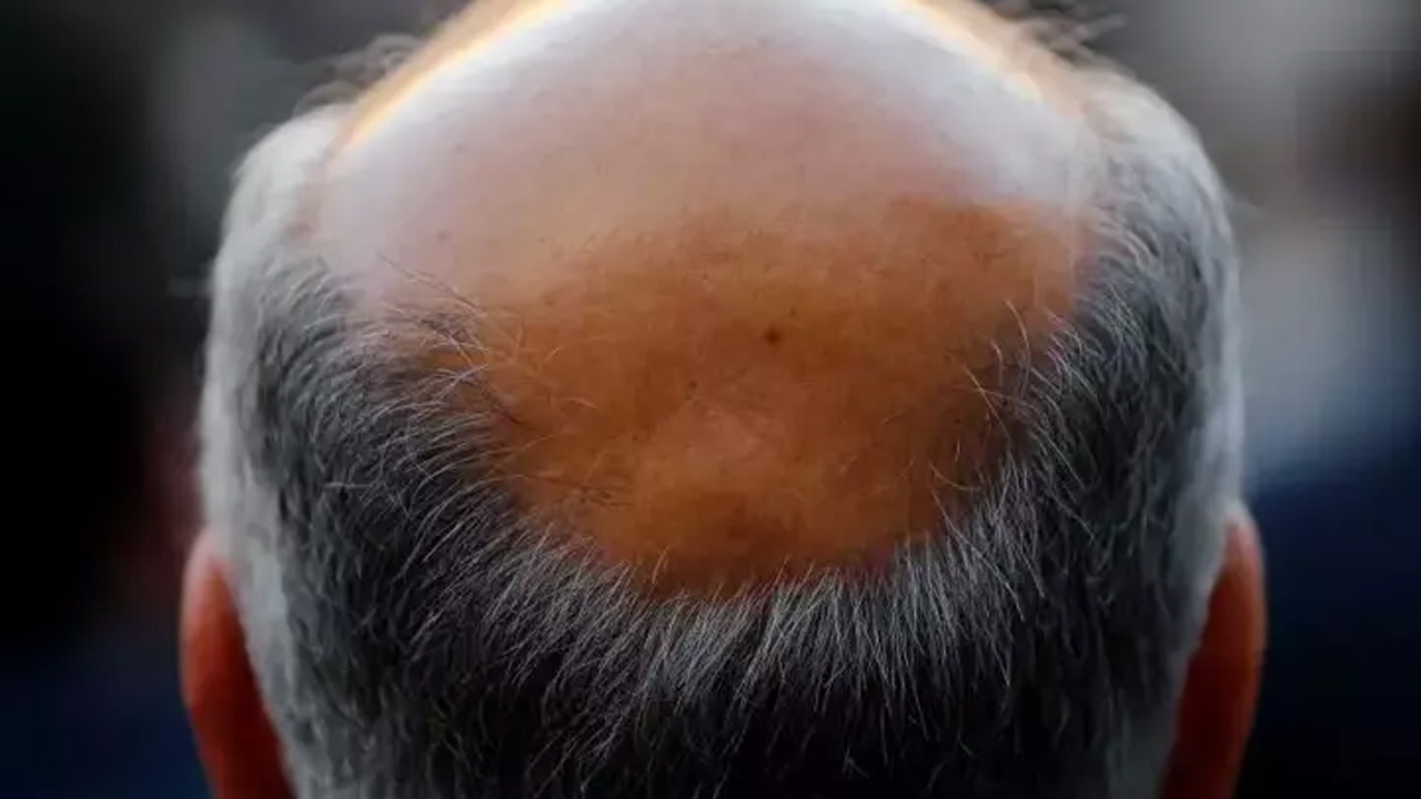 Gizemli salgın şoku! 155 kişi bir anda saçlarını kaybetti