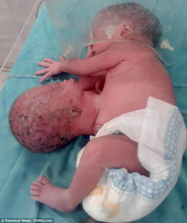 Foto - Gövdesine yapışık bir kafayla doğdu